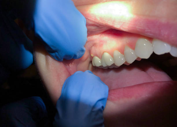 Best Emergency Wisdom Tooth Extraction in Branford Center, CT